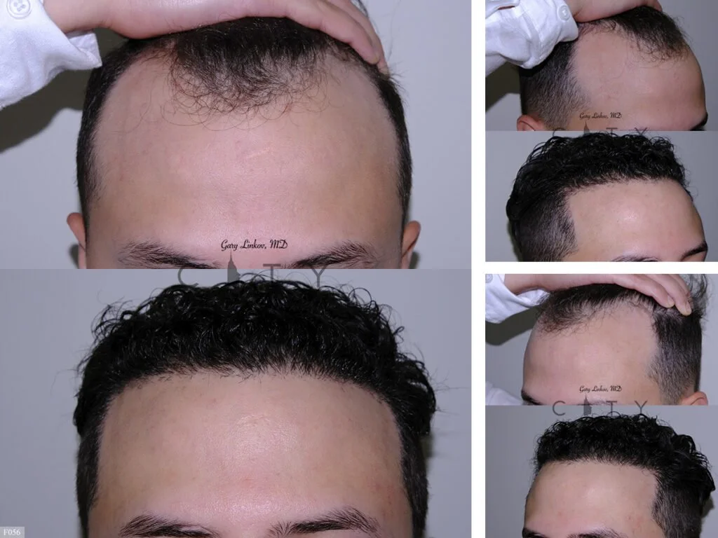 Hair-Transplant-F06