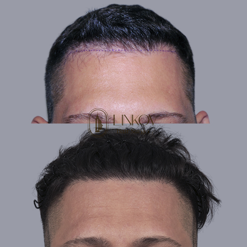 Central Centrifugal Cicatricial Alopecia Doctors NYC