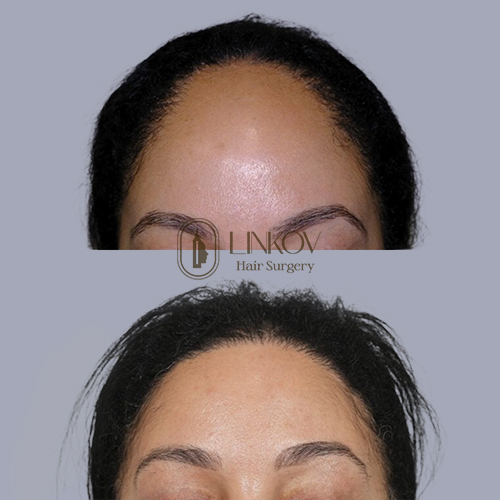 Hair Transplant For Women in NYC