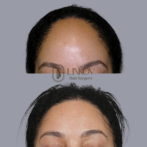 NYC Female Hair Loss Treatment