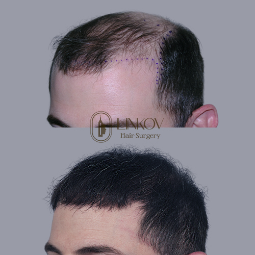 Male Hair Transplant in New York City