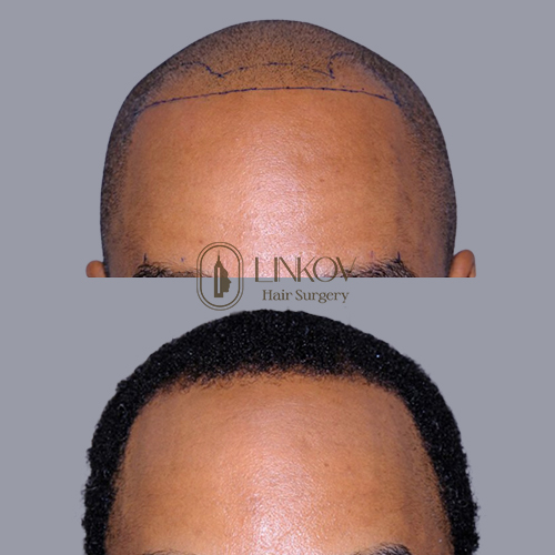 Hair Transplants for African Americans NYC