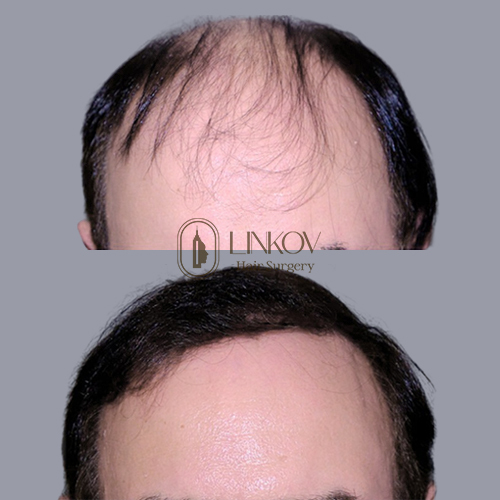 Hair Transplant NYC