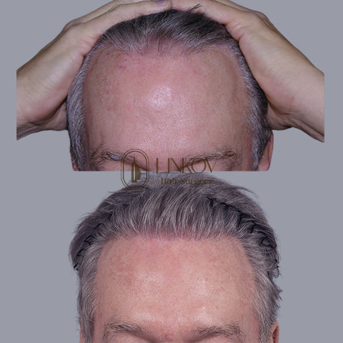 Follicular Unit Extraction (FUE) in NYC