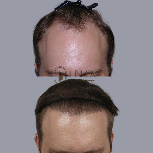 Follicular Unit Transplantation (FUT) in NYC