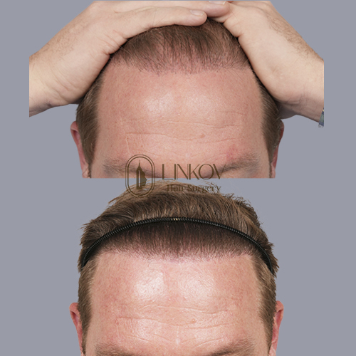 Best Hair Loss Treatments in NYC