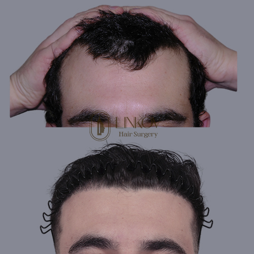 NYC Male Hair Loss Treatments