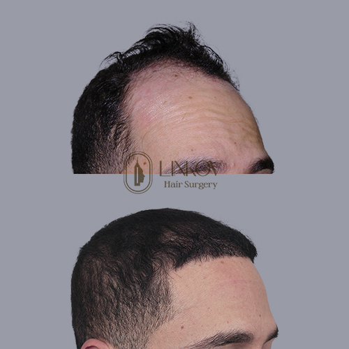 Alopecia Areata (Autoimmune Condition)