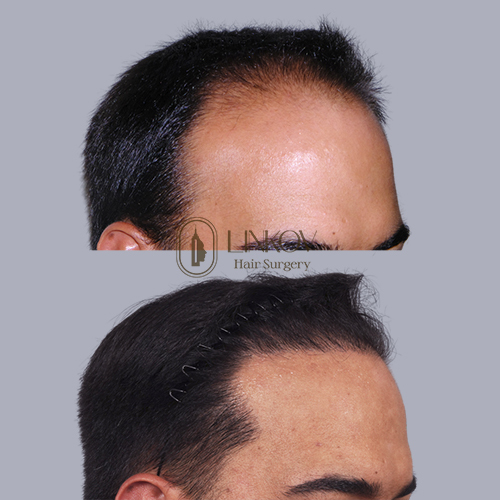 Celebrity Hair Transplant in NYC