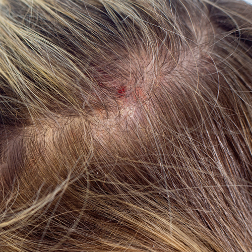 Treatments for Dissecting Cellulitis of the Scalp NYC