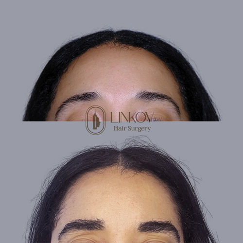 Eyebrow Restoration in New York City