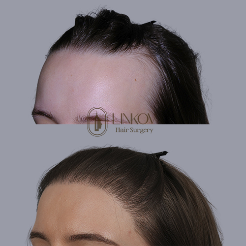 NYC Female Hair Loss Treatment (Female Pattern Baldness)