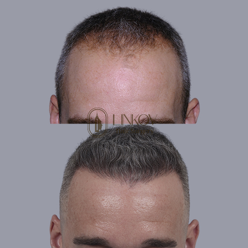 Finasteride for Hair Loss in NYC