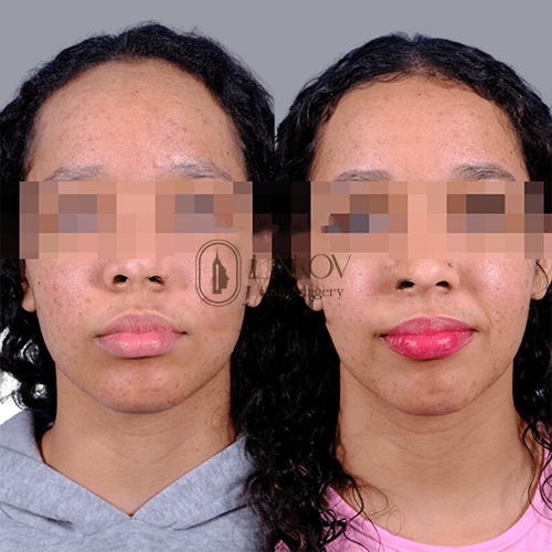 Forehead Reduction Surgery NYC