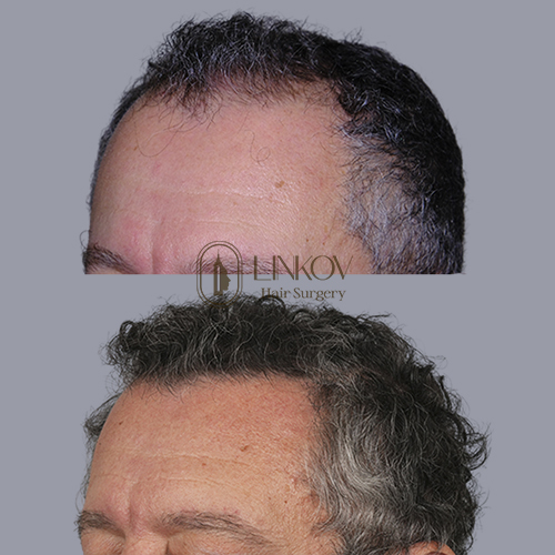 NYC Laser Hair Loss Therapy