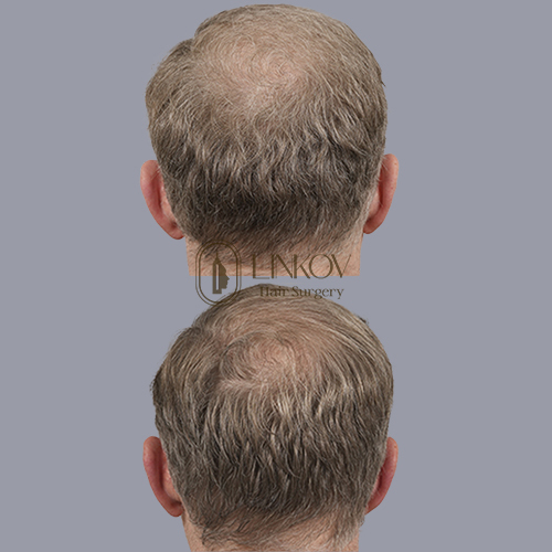 Male Pattern Hair Loss Treatment NYC