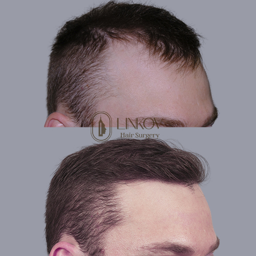 NYC Medications For Hair Loss