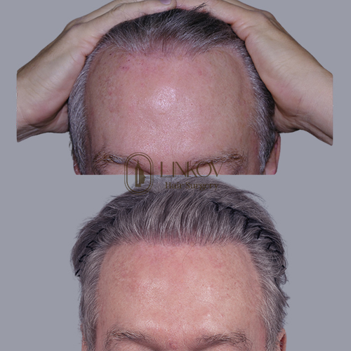 Minoxidil for Hair Loss NYC