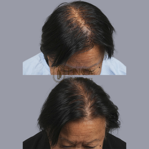 PCOS Hair Loss Treatment NYC