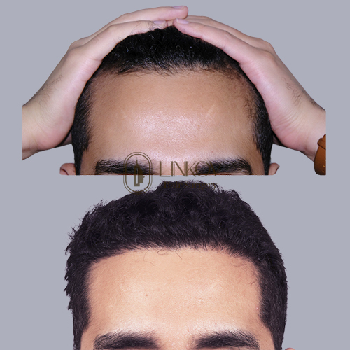 Scalp Micro Pigmentation