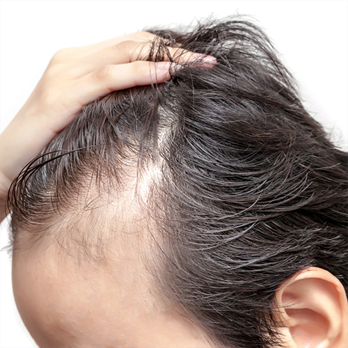 Traction Alopecia