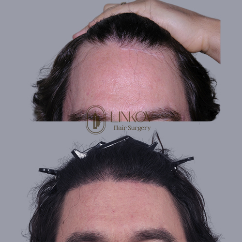 Transgender Hair Transplant Surgery NYC